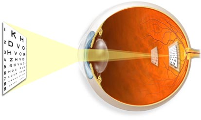 What is Astigmatism? What is Astigmatism?